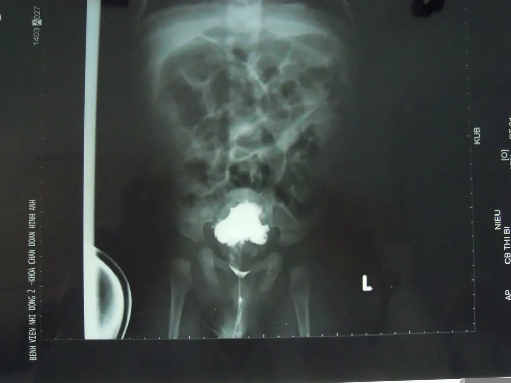 Trẻ bị vỡ bàng quang do dị tật niệu ảnh 2 Trẻ bị vỡ bàng quang do dị tật niệu ảnh 2